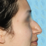 Rhinoplasty Before & After Patient #1450