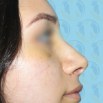 Rhinoplasty Before & After Patient #1450
