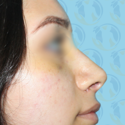 Rhinoplasty Before & After Patient #1450