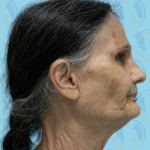 Facelift Before & After Patient #1699