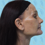 Facelift Before & After Patient #1699
