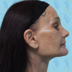 Facelift Before & After Patient #1699