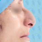 Rhinoplasty Before & After Patient #1443