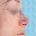 Rhinoplasty Before & After Patient #1443