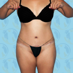 Tummy Tuck Before & After Patient #2712