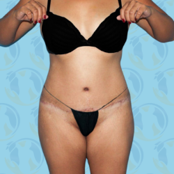 Tummy Tuck Before & After Patient #2712
