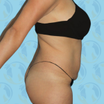 Tummy Tuck Before & After Patient #864