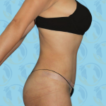 Tummy Tuck Before & After Patient #864