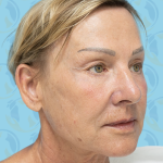 Facelift Before & After Patient #1500