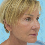 Facelift Before & After Patient #1500