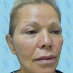 Facelift Before & After Patient #1497