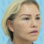 Facelift Before & After Patient #1497