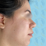Chin Implant Before & After Patient #2648