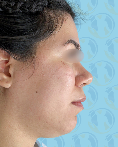 Chin Implant Before & After Patient #2648