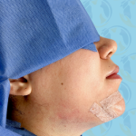 Chin Implant Before & After Patient #2648