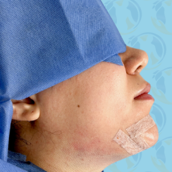 Chin Implant Before & After Patient #2648