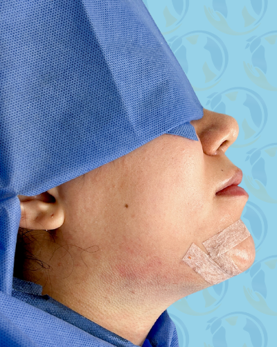 Chin Implant Before & After Patient #2648