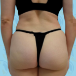 Glute Implant Before & After Patient #2651