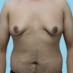Gynecomastia Before & After Patient #2656