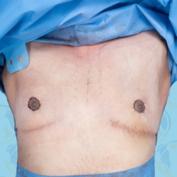 Gynecomastia Before & After Patient #2656