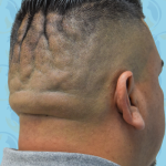 Scalp Remodeling Before & After Patient #2706