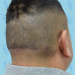 Scalp Remodeling Before & After Patient #2706