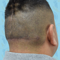 Scalp Remodeling Before & After Patient #2706