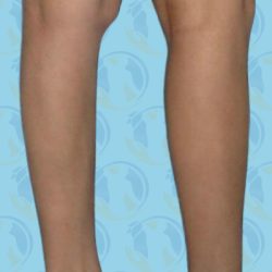 Calf Implants Before & After Patient #2842