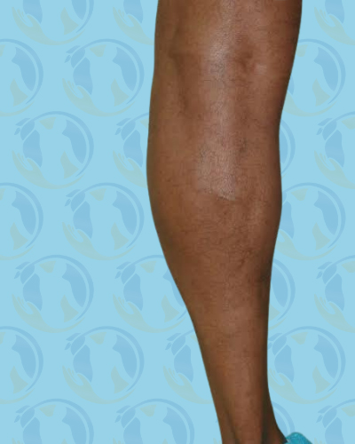 Calf Implants Before & After Patient #2843