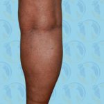Calf Implants Before & After Patient #2843