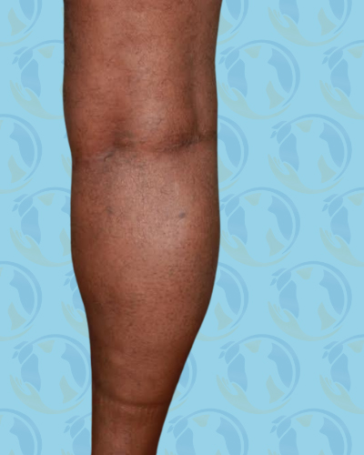 Calf Implants Before & After Patient #2843