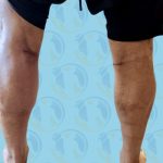 Calf Implants Before & After Patient #2844