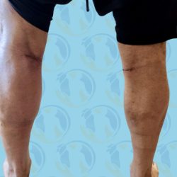 Calf Implants Before & After Patient #2844