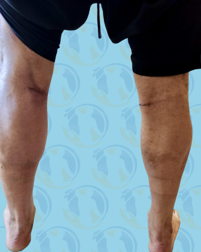 Calf Implants Before & After Patient #2844