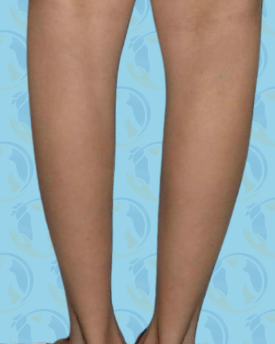Calf Implants Before & After Patient #2845