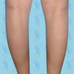 Calf Implants Before & After Patient #2845