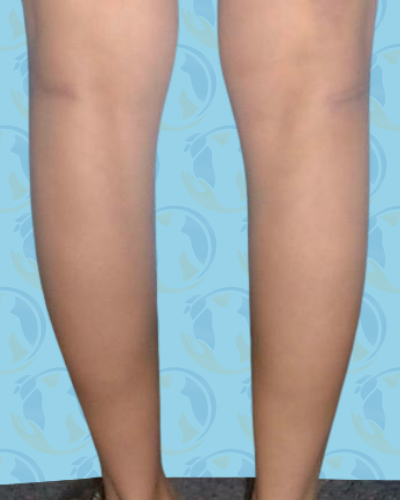 Calf Implants Before & After Patient #2845