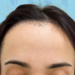 Forehead Reduction Before & After Patient #2846