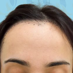 Forehead Reduction Before & After Patient #2846