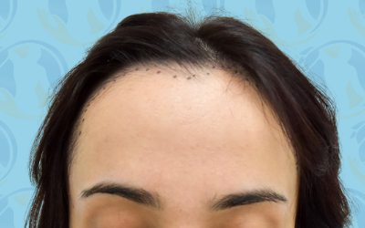 Forehead Reduction Before & After Patient #2846