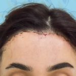 Forehead Reduction Before & After Patient #2846