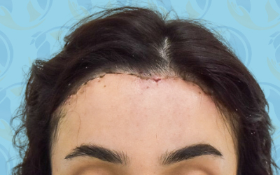 Forehead Reduction Before & After Patient #2846