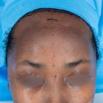 Forehead Reduction Before & After Patient #2847