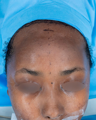 Forehead Reduction Before & After Patient #2847