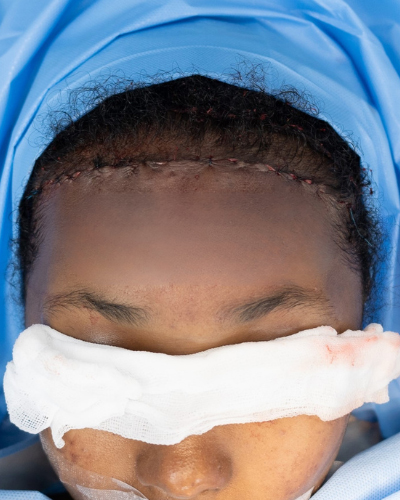 Forehead Reduction Before & After Patient #2847