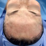 Forehead Reduction Before & After Patient #2848