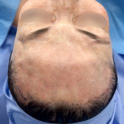 Forehead Reduction Before & After Patient #2848