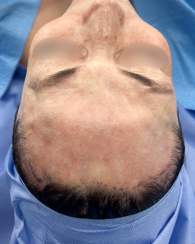 Forehead Reduction Before & After Patient #2848