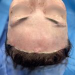 Forehead Reduction Before & After Patient #2848