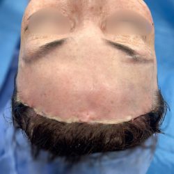 Forehead Reduction Before & After Patient #2848